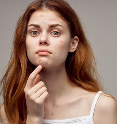 Saiba quais são as causas das espinhas no rosto